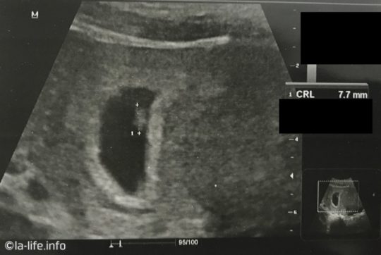 アメリカで産婦人科初受診。妊娠初期の超音波検査