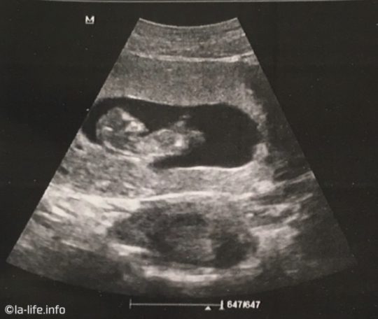 アメリカで妊娠・出産、２回目の産婦人科検診・10週目の赤ちゃんの超音波画像