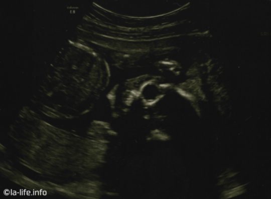 妊娠20週目の赤ちゃんの超音波画像・セカンドトライメスター